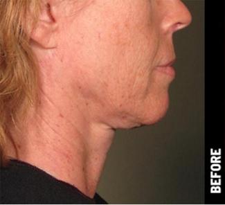Ultherapy Before & After Patient #1557